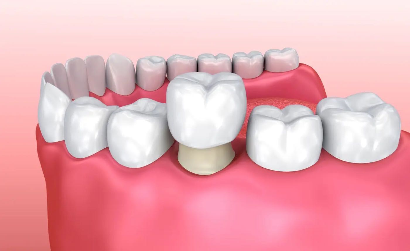 Crowns at Dynamic Dental in Bluefield, WV