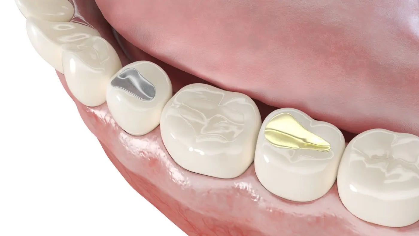 Tooth-Colored Fillings