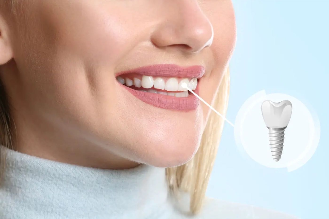 Single Tooth Implants